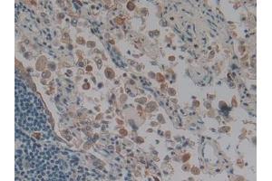 DAB staining on IHC-P; Samples: Human Lung cancer Tissue