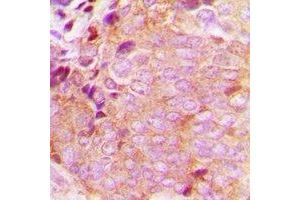 Immunohistochemical analysis of CaMKK beta staining in human breast cancer formalin fixed paraffin embedded tissue section. (CAMKK2 anticorps)