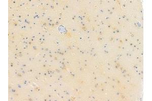 ABIN6257252 and ABIN6273611 at 1/100 staining human glioblastoma by IHC-P. (HSPB8 anticorps  (C-Term))