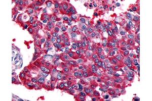 Anti-CALCRL / CGRP Receptor antibody IHC of human Lung, Non-Small Cell Carcinoma. (CALCRL anticorps  (Cytoplasmic Domain))