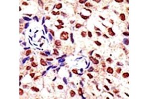 IHC analysis of FFPE human breast carcinoma tissue stained with the PRMT2 antibody (PRMT2 anticorps  (AA 22-53))