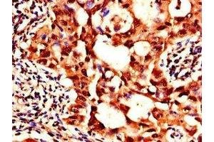 Immunohistochemistry of paraffin-embedded human lung cancer using ABIN7169181 at dilution of 1:100