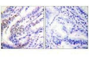 Immunohistochemical analysis of paraffin-embedded human lung carcinoma tissue using Cyclin E1 antibody.