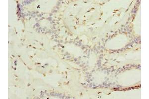 Immunohistochemistry of paraffin-embedded human breast cancer using ABIN7157236 at dilution of 1:100