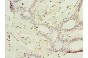 Immunohistochemistry of paraffin-embedded human breast cancer using ABIN7157236 at dilution of 1:100 (KATNAL2 anticorps  (AA 18-307))