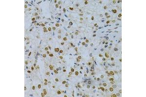 Immunohistochemistry of paraffin-embedded human kidney cancer using ELAVL1 Antibody.