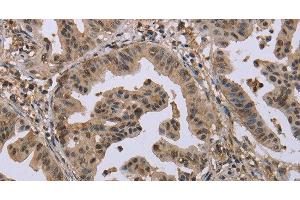 Immunohistochemistry of paraffin-embedded Human gastric cancer tissue using MCC Polyclonal Antibody at dilution 1:30 (MCC anticorps)
