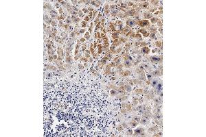 Immunohistochemical analysis of paraffin-embedded Human hepatocarcinoma tissue using (ABIN654629 and ABIN2844325) performed on the Leica® BOND RXm. (BCKDHB anticorps  (N-Term))