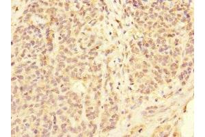 Immunohistochemistry of paraffin-embedded human ovarian cancer using ABIN7158545 at dilution of 1:100 (FCGR2C anticorps  (AA 43-223))