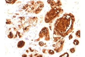 Formalin-fixed, paraffin-embedded human Breast Carcinoma stained with MUC1 Mouse Recombinant Monoclonal Antibody (rMUC1/960). (Recombinant MUC1 anticorps)