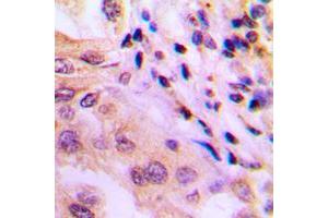 Immunohistochemical analysis of p65 (pT60) staining in human lung cancer formalin fixed paraffin embedded tissue section.
