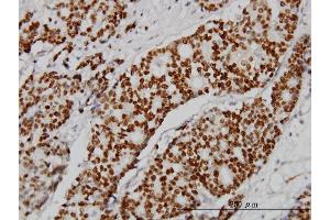 Immunoperoxidase of monoclonal antibody to PGR on formalin-fixed paraffin-embedded human breast cancer.