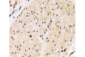 Immunohistochemistry of paraffin-embedded Human stomach cancer using TMPRSS2 Polyclonal Antibody at dilution of 1:200 (40x lens).