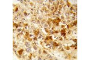 Immunohistochemistry analysis of human hepatocarcinoma (Formalin-fixed, Paraffin-embedded)  using Peroxin 2 / PEX2 / RNF72  Antibody , followed by peroxidase-conjugated secondary antibody and DAB staining.