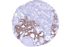 Thyroid CDH16 negative papillary carcinoma invading CDH16 positive normal thyroid CDH16 immunohistochemistry (Recombinant Cadherin-16 anticorps)