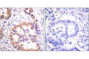 Immunohistochemistry analysis of paraffin-embedded human lung carcinoma, using Tuberin/TSC2 (Phospho-Ser939) Antibody.