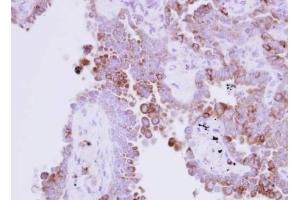 IHC-P Image Immunohistochemical analysis of paraffin-embedded human lung adenocarcinoma, using Ribonuclease A, antibody at 1:250 dilution. (RNASE1 anticorps  (Center))