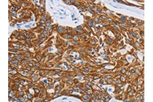 The image on the left is immunohistochemistry of paraffin-embedded Human esophagus cancer tissue using ABIN7191483(MMP21 Antibody) at dilution 1/15, on the right is treated with synthetic peptide. (MMP21 anticorps)