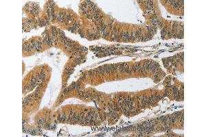 Immunohistochemistry of Human gastric cancer using PIK3R3 Polyclonal Antibody at dilution of 1:45 (PIK3R3 anticorps)