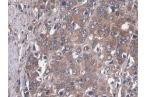 DAB staining on IHC-P; Samples: Human Prostate cancer Tissue (MAP4 anticorps  (AA 243-549))