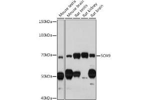Immunohistochemistry of paraffin-embedded human thyroid cancer using SOX9 Rabbit pAb (ABIN1682861, ABIN5664083, ABIN5664085 and ABIN6219552) at dilution of 1:100 (40x lens).