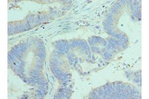 Immunohistochemistry of paraffin-embedded human colon cancer using ABIN7144450 at dilution of 1:100 (BCL2L14 anticorps  (AA 1-327))