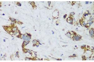 Immunohistochemistry of paraffin-embedded Human gastric cancer using ECH1 Polyclonal Antibody at dilution of 1:150 (40x lens). (ECH1 anticorps)