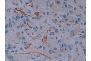 Detection of PLS3 in Human Prostate cancer Tissue using Polyclonal Antibody to Plastin 3 (PLS3) (Plastin 3 anticorps  (AA 379-630))