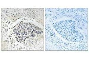Immunohistochemistry analysis of paraffin-embedded human lung carcinoma tissue using CPNE8 antibody. (CPNE8 anticorps  (N-Term))
