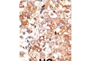 Formalin-fixed and paraffin-embedded human cancer tissue reacted with the primary antibody, which was peroxidase-conjugated to the secondary antibody, followed by DAB staining.