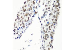 Immunohistochemistry of paraffin-embedded human lung cancer using HT antibody  at dilution of 1:100 (40x lens). (HTATSF1 anticorps  (AA 1-270))