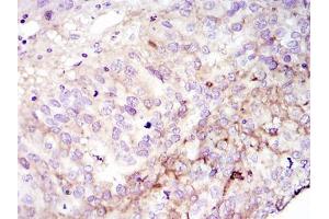 Immunohistochemical analysis of paraffin-embedded cervices tumour using FAK mouse mAb with DAB staining