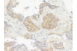 ABIN6256392 and ABIN6267376 at 1/100 staining human lung squamous cell carcinoma by IHC-P. (Glycogen Synthase anticorps  (pSer645))