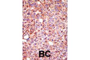 Formalin-fixed and paraffin-embedded human cancer tissue reacted with MGAT3 polyclonal antibody  , which was peroxidase-conjugated to the secondary antibody, followed by AEC staining . (MGAT3 anticorps  (N-Term))
