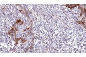 ABIN6277553 at 1/100 staining Human urothelial cancer tissue by IHC-P. (CD42a anticorps  (Internal Region))