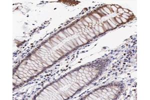 ABIN6267547 at 1/200 staining human colon cancer tissue sections by IHC-P. (VASP anticorps  (pSer239))