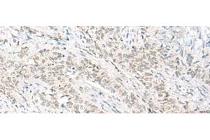 Immunohistochemistry of paraffin-embedded Human ovarian cancer tissue using HABP4 Polyclonal Antibody at dilution of 1:60(x200) (HABP4 anticorps)