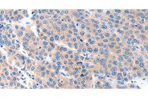 Immunohistochemistry of paraffin-embedded Human liver cancer tissue using KLK2 Polyclonal Antibody at dilution 1:100 (Kallikrein 2 anticorps)