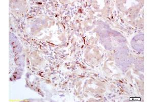 Formalin-fixed and paraffin embedded human lung carcinoma labeled with Rabbit Anti-FAK gamma Polyclonal Antibody (ABIN675189) at 1:200 followed by conjugation to the secondary antibody and DAB staining. (FAK anticorps  (AA 901-1052))