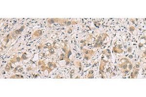 Immunohistochemistry of paraffin-embedded Human liver cancer tissue using RTP4 Polyclonal Antibody at dilution of 1:80(x200) (RTP4 anticorps)