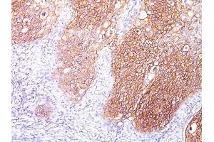Formalin-fixed, paraffin-embedded human Lung SqCC stained with EGFR Mouse Monoclonal Antibody (GFR/1667). (EGFR anticorps)