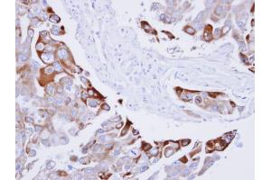 IHC-P Image Immunohistochemical analysis of paraffin-embedded H441 xenograft , using RAC1, antibody at 1:100 dilution.