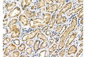 ABIN6257582 and ABIN6275689 at 1/100 staining Human kidney cancer and adjacent normal tissues by IHC-P. (ZFYVE19 anticorps  (Internal Region))