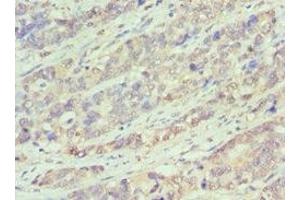 Immunohistochemistry of paraffin-embedded human endometrial cancer using ABIN7145167 at dilution of 1:100 (Cyclin D1 anticorps  (AA 1-233))