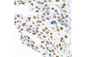 Immunohistochemistry of paraffin-embedded human prostate cancer using PTBP1 antibody (ABIN5995415) at dilution of 1/100 (40x lens). (PTBP1 anticorps)