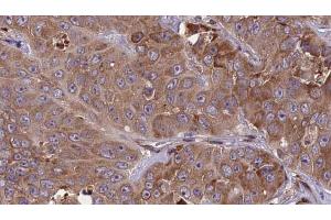 ABIN6273840 at 1/100 staining Human liver cancer tissue by IHC-P.