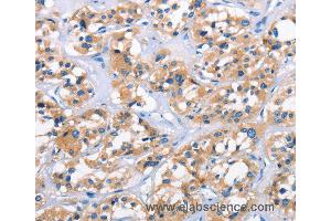 Immunohistochemistry of Human thyroid cancer using APOL6 Polyclonal Antibody at dilution of 1:50 (APOL6 anticorps)