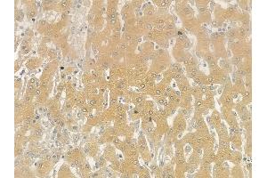 ABIN6257770 and ABIN6275494 at 1/100 staining human hepatocellular carcinoma by IHC-P.
