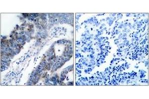 Immunohistochemistry analysis of paraffin-embedded human breast carcinoma tissue, using ASK1 (Ab-83) Antibody. (ASK1 anticorps  (AA 49-98))