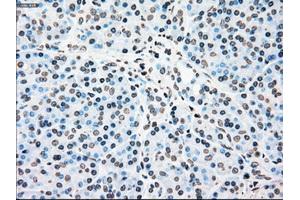 Immunohistochemical staining of paraffin-embedded Carcinoma of kidney tissue using anti-PLK1mouse monoclonal antibody. (PLK1 anticorps)
